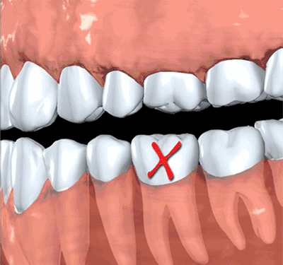 牙齿掉了有3种方式可以修补，你适合哪一种？