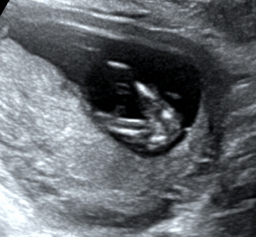 怀孕3个月有什么反应？3个月的胎儿图及孕期症状反应